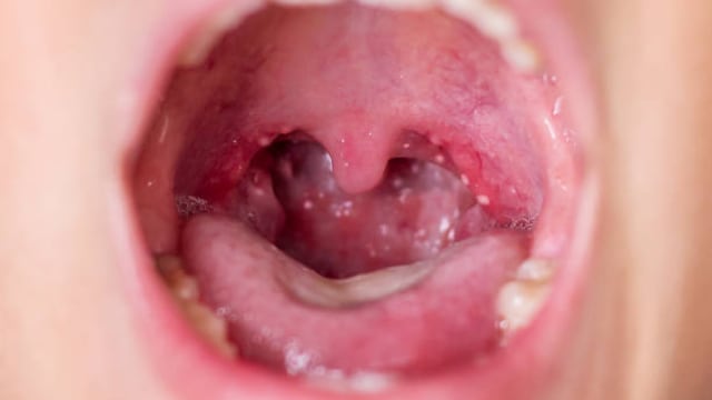 Causes, Prevention, Signs Of Tonsil Stones: All You Need To Know About Tonsillotiths