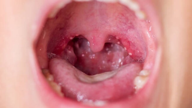 Causes, Prevention, Signs Of Tonsil Stones: All You Need To Know About Tonsillotiths