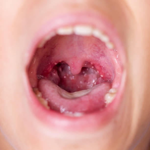 Causes, Prevention, Signs Of Tonsil Stones: All You Need To Know About Tonsillotiths