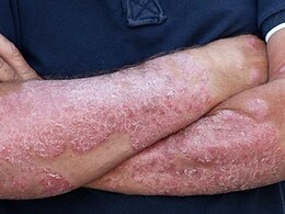 स्किन पर होती है खुजली तो हो जाएं सावधान, हो सकता है  एटोपिक डर्माटाइटिस के लक्षण, जान लें इसके कारण