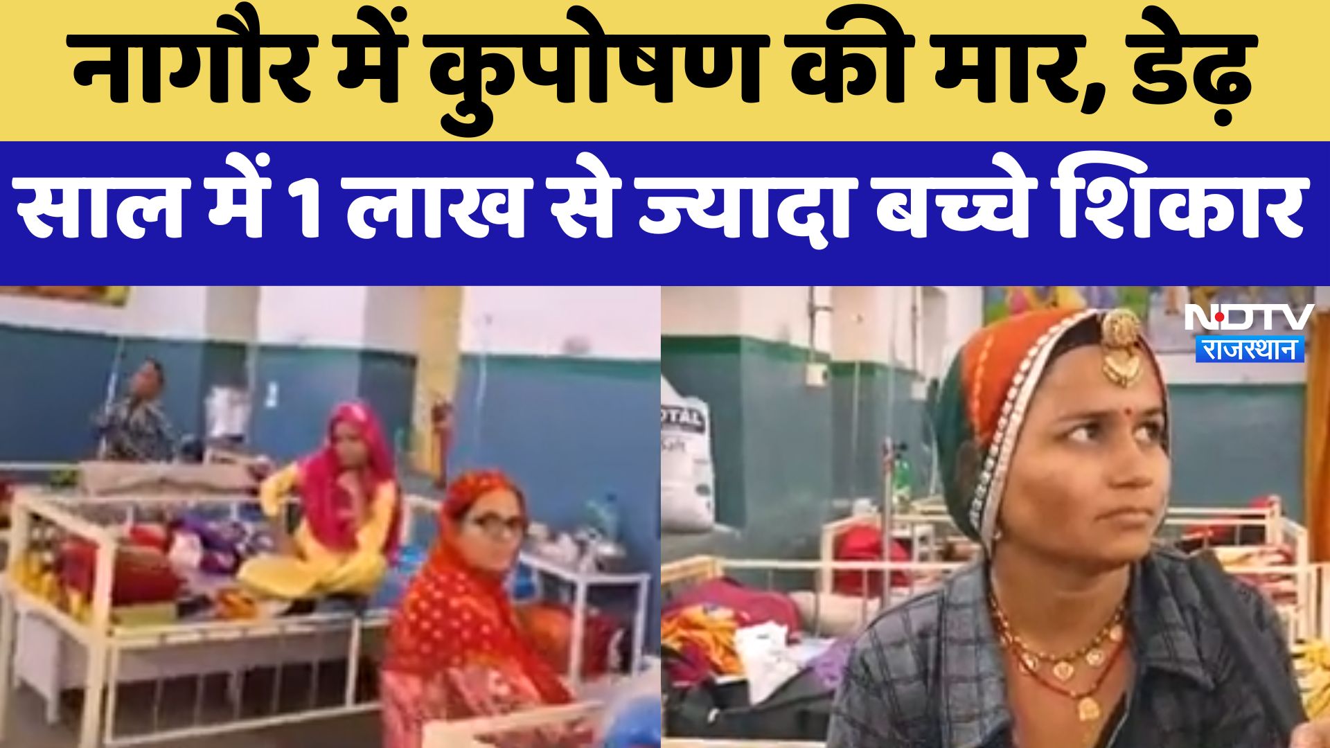 Nagore News : नागौर में कुपोषण की मार, डेढ़ साल में 1 लाख से ज्यादा बच्चे शिकार