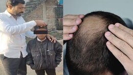 Buldhana Hair Loss : व्हायरसमुळे बुलढाण्यातील गावकऱ्यांना पडतंय टक्कल? केसगळतीत महिलांची संख्या लक्षणीय
