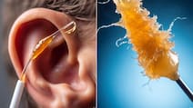 कान का मेल कैसे निकालें? सिर्फ 2 बूंद में सारी गंदगी आ जाएगी बाहर