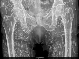 Shocking X-ray Reveals Human Body Infested With Tapeworm Larvae Shocking X-ray Reveals Human Body Infested With Tapeworm Larvae
