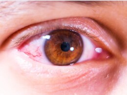 Buldhana News : डोक्यावर पुन्हा केस आले, पण डोळ्यांची वाट लागली; बुलढाण्यातील गावकऱ्यांसमोर नवं संकट