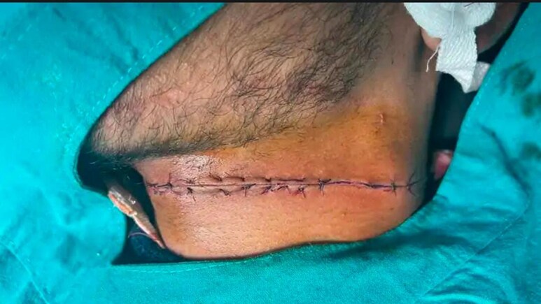 चाइनीज मांझे से कटा बाइक सवार युवक का लगा, लगे 16 टांके; UP में पुलिस कांस्टेबल की गई जान
