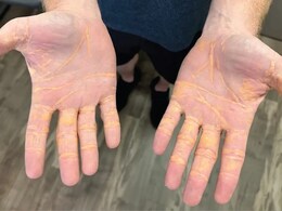 Man Ate Only Cheese, Butter, Hamburgers On Carnivore Diet - Develops Oozy Yellow Nodules On Body Man Ate Only Cheese, Butter, Hamburgers On Carnivore Diet - Develops Oozy Yellow Nodules On Body