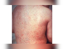 युगांडा में खसरे के प्रकोप से पांच बच्चों की मौत, जानिए क्या है इस बीमारी के लक्षण और बचाव युगांडा में खसरे के प्रकोप से पांच बच्चों की मौत, जानिए क्या है इस बीमारी के लक्षण और बचाव