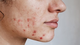 Use These Natural Ingredients For Cystic Acne Treatment