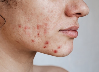 Adult Acne: Know Possible Causes And Treatment Options