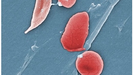 Sickle Cell Anaemia And Pregnancy: Doctor Explains The Risks Involved