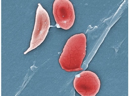 Sickle Cell Anaemia And Pregnancy: Doctor Explains The Risks Involved