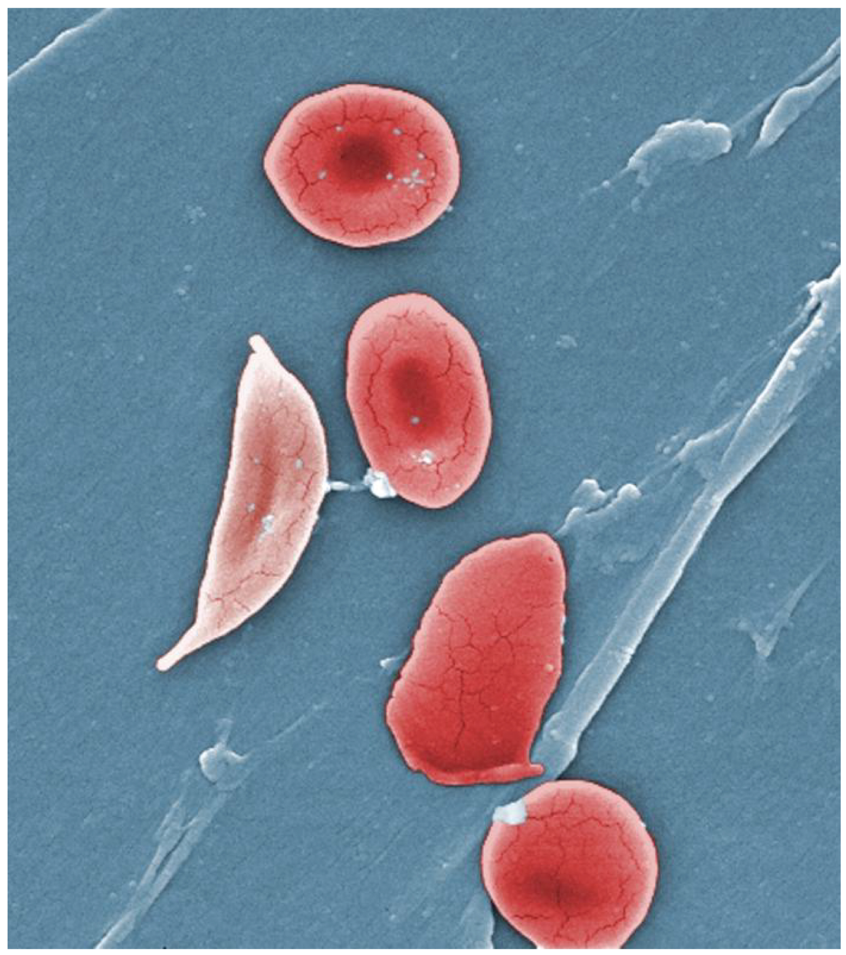 Sickle Cell Anaemia And Pregnancy: Doctor Explains The Risks Involved