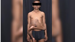AIIMS Doctors Conduct Surgery On Boy With 2 Extra Feet Attached To Stomach