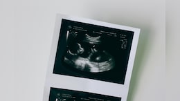 Baby Successfully Treated For Deadly Motor Neuron Diseases While Still In Womb