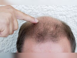 Buldhana Bald Virus: बुलडाण्यातील लोकांच्या केसगळतीमागील कारण पंजाबचे गहू, काय आहे होशियारपूर कनेक्शन?