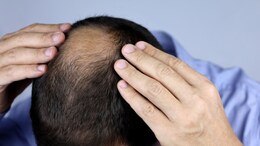 Buldhana hair loss : बुलढाण्यात अचानकपणे केसगळती का सुरू झाली? संशोधनातून धक्कादायक खुलासा