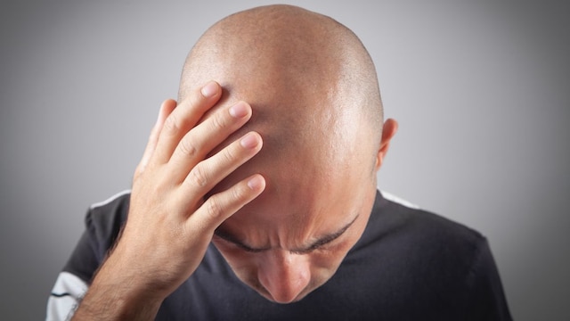 Male Pattern Baldness: How To Spot It Early And What You Can Do