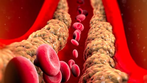 Heart Health: Simple Tweaks To Better Manage Bad Cholesterol