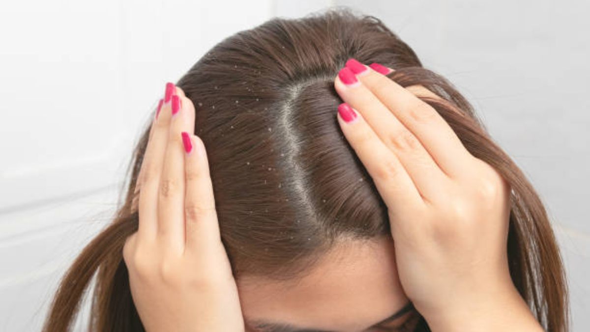 Dandruff Can Trigger These 4 Scalp Problems