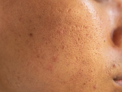 Open Pores On Face: Here Are 5 Home Remedies To Follow
