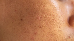 Open Pores On Face: Here Are 5 Home Remedies To Follow