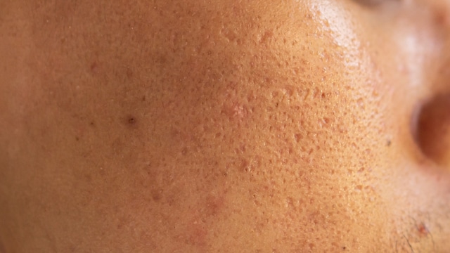 Multani mitti is known for absorbing excess oil and impurities