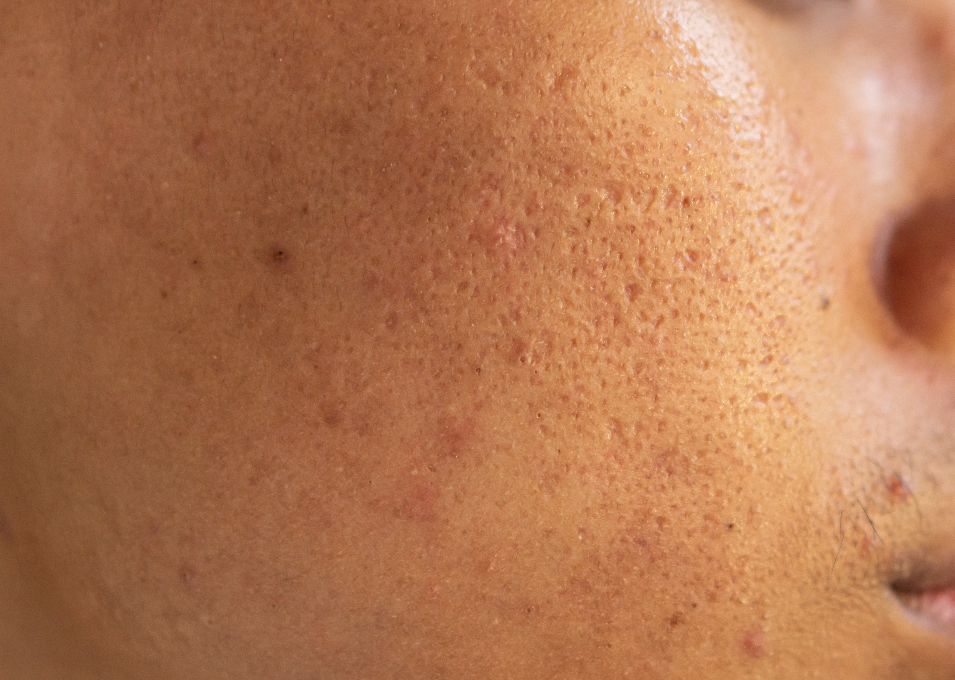 Multani mitti is known for absorbing excess oil and impurities