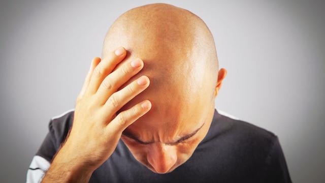 Explained: How An Acne Drug Can Treat Male Pattern Baldness