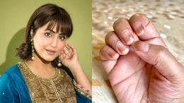 Hina Khan, Battling Cancer, On Side-Effects Of Chemotherapy: "My Nails Have Become Brittle And Dry"