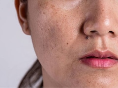 Pigmentation, Dullness, And Uneven Patches- Expert Shares Tips To Get Even Skin Tone