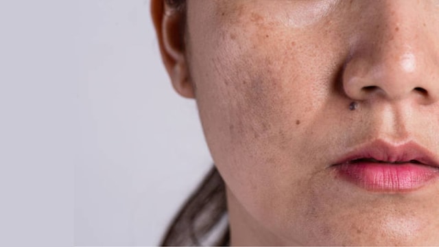Achieving an even skin tone goes beyond lightening spots
