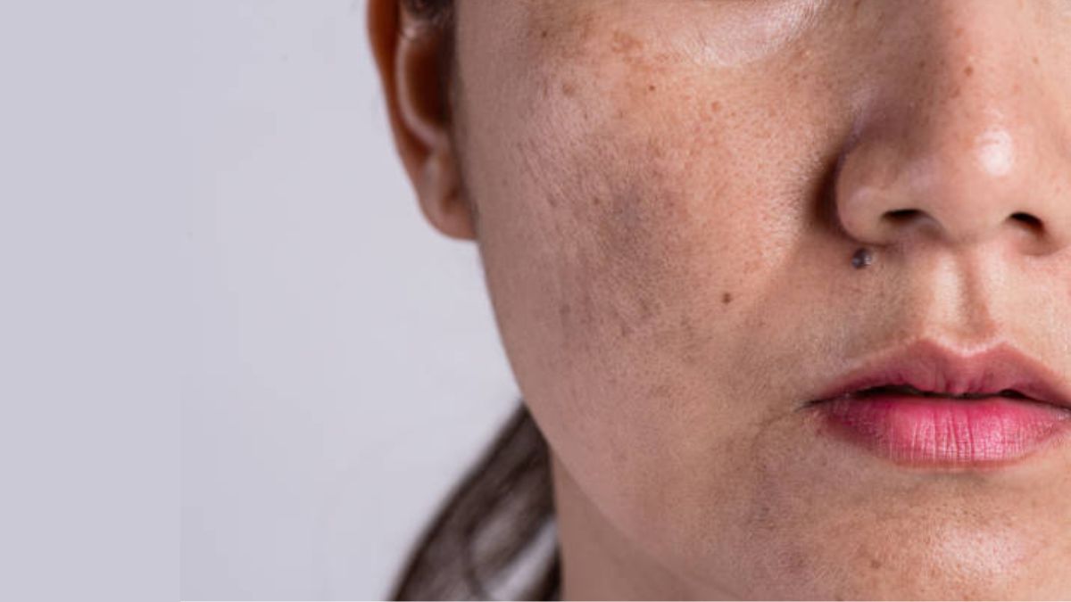 Achieving an even skin tone goes beyond lightening spots