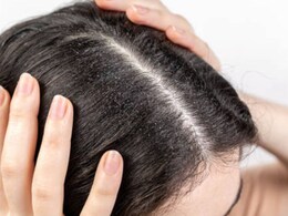 Dandruff होने पर कितने दिनों में बाल धोने चाहिए? यहां जानें डैंड्रफ से छुटकारा पाने का सबसे आसान तरीका Dandruff होने पर कितने दिनों में बाल धोने चाहिए? यहां जानें डैंड्रफ से छुटकारा पाने का सबसे आसान तरीका