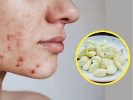 क्या चेहरे पर लहसुन रगड़ने से Pimple ठीक हो जाते हैं? स्किन की डॉक्टर से जानें Garlic के फायदे-नुकसान क्या चेहरे पर लहसुन रगड़ने से Pimple ठीक हो जाते हैं? स्किन की डॉक्टर से जानें Garlic के फायदे-नुकसान