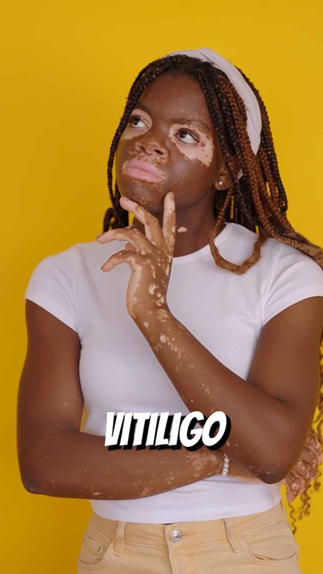Fact Check: Does Consuming Fish And Milk Together Cause Vitiligo?