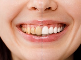 ब्रश करने के बाद भी दिखते हैं दांत पीले, तो जानें Teeth Whitening के लिए 5 आसान घरेलू नुस्खे, मोतियों से चमक उठेंगे दांत