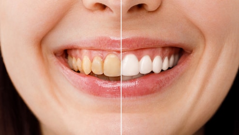 ब्रश करने के बाद भी दिखते हैं दांत पीले, तो जानें Teeth Whitening के लिए 5 आसान घरेलू नुस्खे, मोतियों से चमक उठेंगे दांत