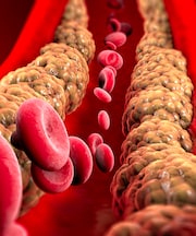 Bad cholesterol के Symptoms क्या हैं? इसे 'साइलेंट किलर' क्यों कहते हैं, जानिए यहां