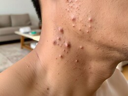 लाइफस्टाइल के चलते भी हो सकते हैं गर्दन पर मस्से, जानें गर्दन पर मस्से क्यों होते हैं और गर्दन से मस्से हटाने के क्या उपाय हैं? लाइफस्टाइल के चलते भी हो सकते हैं गर्दन पर मस्से, जानें गर्दन पर मस्से क्यों होते हैं और गर्दन से मस्से हटाने के क्या उपाय हैं?