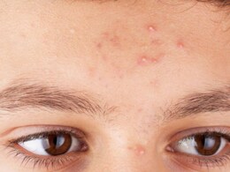 हर थोड़े दिनों में हो जाते हैं माथे पर पिंपल? स्किन एक्सपर्ट ने बताए छुटकारा पाने के 4 आसान तरीके हर थोड़े दिनों में हो जाते हैं माथे पर पिंपल? स्किन एक्सपर्ट ने बताए छुटकारा पाने के 4 आसान तरीके