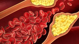 Should You Take Statin For High Cholesterol? Cardiologist Answers