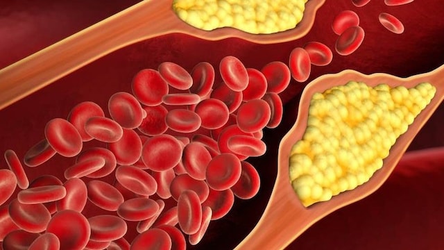 High Cholesterol Symptoms: 6 Signs Of Bad Cholesterol That You Should Know