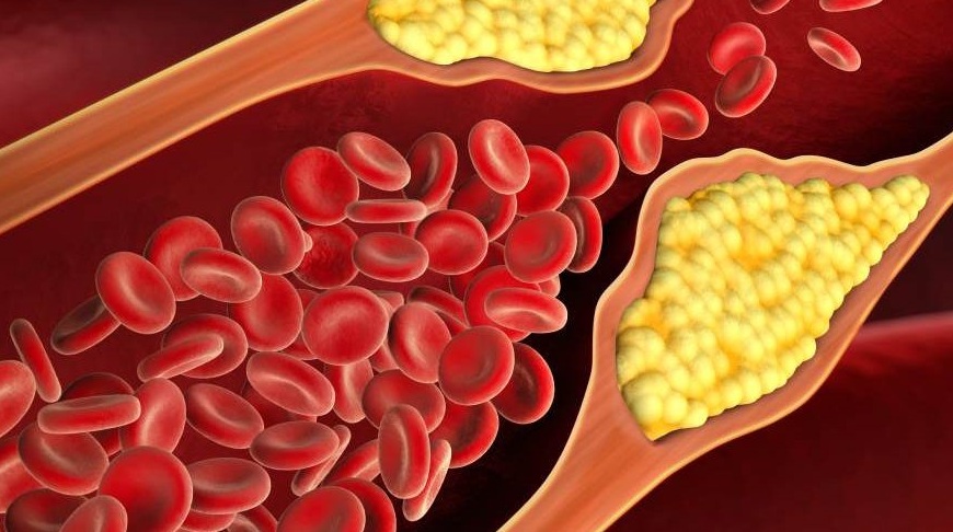 Having high cholesterol levels in youth increases the lifetime risk for heart disease