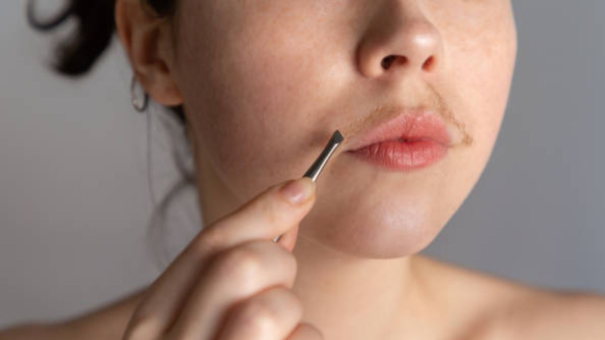 Extra hair growth on areas like the chin, upper lip, chest, back or abdomen can mean increased androgen