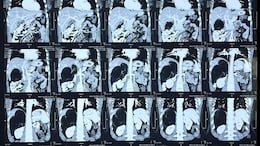 World's Largest Adrenal Tumor Removed Robotically At Delhi Hospital