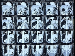 World's Largest Adrenal Tumor Removed Robotically At Delhi Hospital World's Largest Adrenal Tumor Removed Robotically At Delhi Hospital