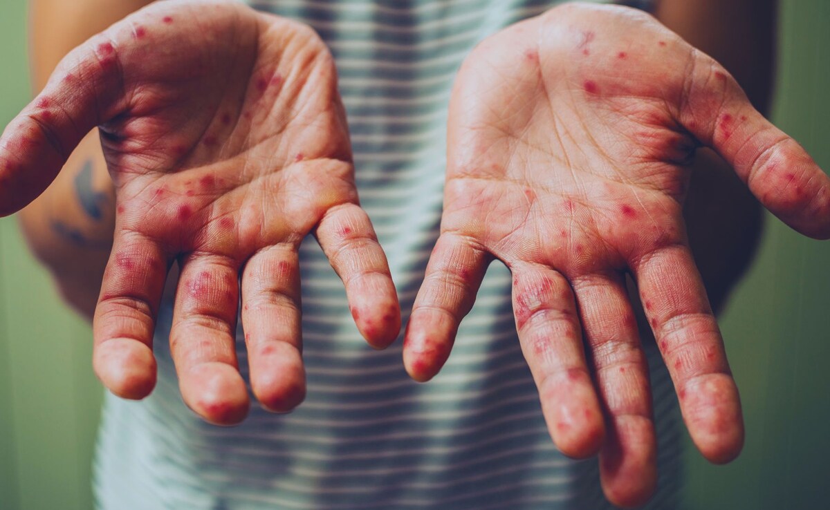 The US Is About To Lose Its Measles-Free Designation: Here's Why