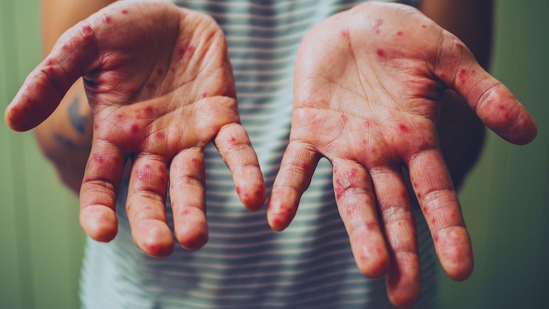 The US Is About To Lose Its Measles-Free Designation: Here's Why