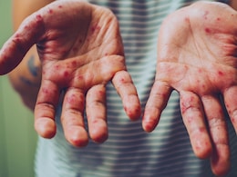 The US Is Having Its Worst Year For Measles In More Than Three Decades The US Is Having Its Worst Year For Measles In More Than Three Decades